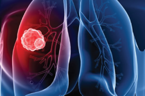 Fig.1 Immagine virtuale 3D dei polmoni e dell’albero bronchiale. In evidenza (rosso) carcinoma del lobo medio del polmone destro.